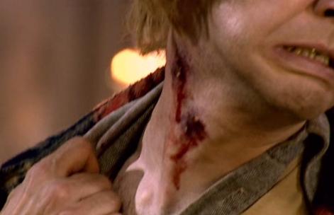 Vampire Bites Suck